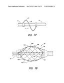 METHODS OF USING A CATHETER HAVING A BRAIDED CONDUCTIVE MEMBER diagram and image