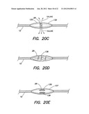 METHODS OF USING A CATHETER HAVING A BRAIDED CONDUCTIVE MEMBER diagram and image