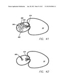 SINGLE FOLD DEVICE FOR TISSUE FIXATION diagram and image