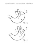 SINGLE FOLD DEVICE FOR TISSUE FIXATION diagram and image