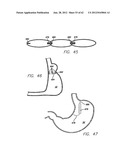 SINGLE FOLD DEVICE FOR TISSUE FIXATION diagram and image