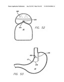 SINGLE FOLD DEVICE FOR TISSUE FIXATION diagram and image