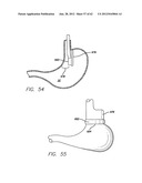 SINGLE FOLD DEVICE FOR TISSUE FIXATION diagram and image