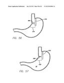 SINGLE FOLD DEVICE FOR TISSUE FIXATION diagram and image
