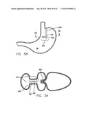 SINGLE FOLD DEVICE FOR TISSUE FIXATION diagram and image