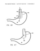 SINGLE FOLD DEVICE FOR TISSUE FIXATION diagram and image