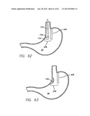 SINGLE FOLD DEVICE FOR TISSUE FIXATION diagram and image