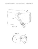 REMOVABLE ANCHORED LUNG VOLUME REDUCTION DEVICES AND METHODS diagram and image