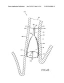 REMOVABLE ANCHORED LUNG VOLUME REDUCTION DEVICES AND METHODS diagram and image