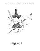 CEMENT-DIRECTING ORTHOPEDIC IMPLANTS diagram and image