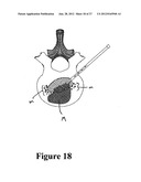 CEMENT-DIRECTING ORTHOPEDIC IMPLANTS diagram and image
