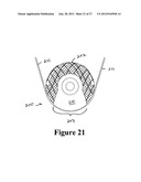 CEMENT-DIRECTING ORTHOPEDIC IMPLANTS diagram and image