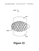 CEMENT-DIRECTING ORTHOPEDIC IMPLANTS diagram and image