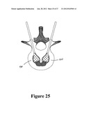 CEMENT-DIRECTING ORTHOPEDIC IMPLANTS diagram and image