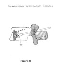 CEMENT-DIRECTING ORTHOPEDIC IMPLANTS diagram and image