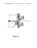 CEMENT-DIRECTING ORTHOPEDIC IMPLANTS diagram and image