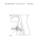 Tracheostomy Tube Having a Sealing Device diagram and image