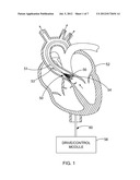 VENTRICULAR ASSIST DEVICE diagram and image