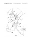 METHOD FOR SYMPATHETIC REBALANCING OF PATIENT diagram and image