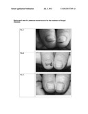 Device and use of a pressure-sound-source for the treatment of fungal     diseases diagram and image