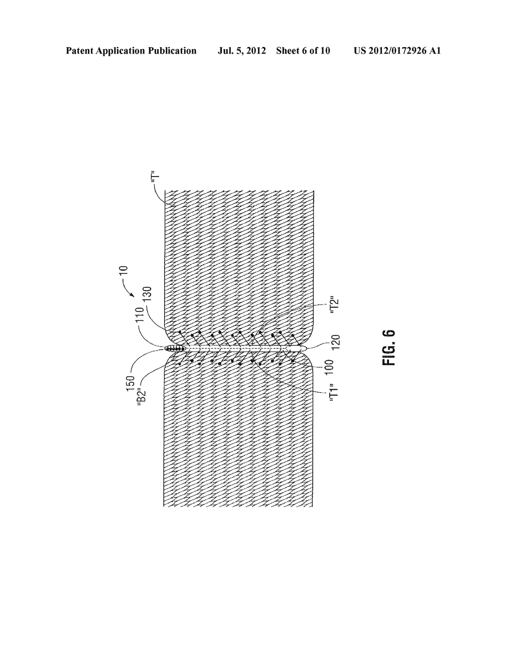 WOUND CLOSURE DEVICE INCLUDING PROGRIP STRAW - diagram, schematic, and image 07