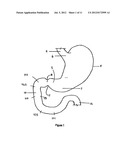 METHODS AND DEVICES TO CURB APPETITE AND/OR REDUCE FOOD INTAKE diagram and image