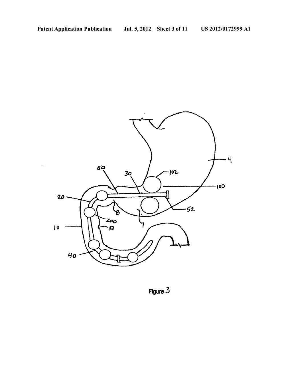 METHODS AND DEVICES TO CURB APPETITE AND/OR REDUCE FOOD INTAKE - diagram, schematic, and image 04