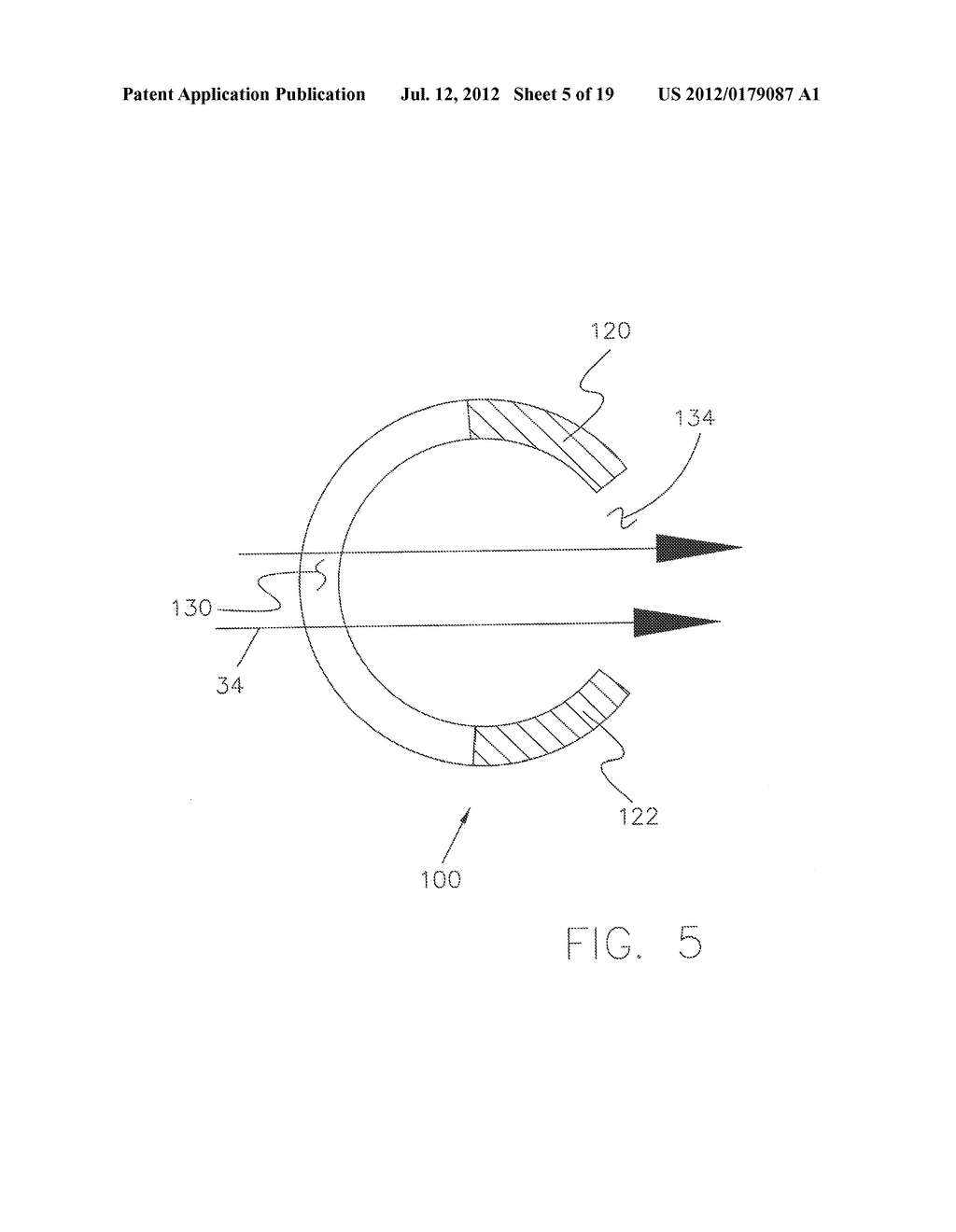 Glaucoma Treatment Method - diagram, schematic, and image 06