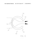 Glaucoma Treatment Method diagram and image