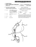 EXTRA-ARTICULAR IMPLANTABLE MECHANICAL ENERGY ABSORBING SYSTEMS AND     IMPLANTATION METHOD diagram and image