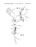 EXTRA-ARTICULAR IMPLANTABLE MECHANICAL ENERGY ABSORBING SYSTEMS AND     IMPLANTATION METHOD diagram and image