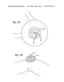 EXTRA-ARTICULAR IMPLANTABLE MECHANICAL ENERGY ABSORBING SYSTEMS AND     IMPLANTATION METHOD diagram and image