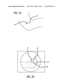 EXTRA-ARTICULAR IMPLANTABLE MECHANICAL ENERGY ABSORBING SYSTEMS AND     IMPLANTATION METHOD diagram and image