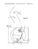 EXTRA-ARTICULAR IMPLANTABLE MECHANICAL ENERGY ABSORBING SYSTEMS AND     IMPLANTATION METHOD diagram and image