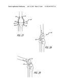 EXTRA-ARTICULAR IMPLANTABLE MECHANICAL ENERGY ABSORBING SYSTEMS AND     IMPLANTATION METHOD diagram and image