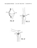 EXTRA-ARTICULAR IMPLANTABLE MECHANICAL ENERGY ABSORBING SYSTEMS AND     IMPLANTATION METHOD diagram and image