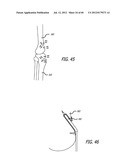 EXTRA-ARTICULAR IMPLANTABLE MECHANICAL ENERGY ABSORBING SYSTEMS AND     IMPLANTATION METHOD diagram and image