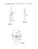 EXTRA-ARTICULAR IMPLANTABLE MECHANICAL ENERGY ABSORBING SYSTEMS AND     IMPLANTATION METHOD diagram and image