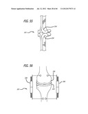 EXTRA-ARTICULAR IMPLANTABLE MECHANICAL ENERGY ABSORBING SYSTEMS AND     IMPLANTATION METHOD diagram and image