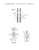 EXTRA-ARTICULAR IMPLANTABLE MECHANICAL ENERGY ABSORBING SYSTEMS AND     IMPLANTATION METHOD diagram and image