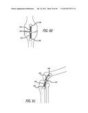 EXTRA-ARTICULAR IMPLANTABLE MECHANICAL ENERGY ABSORBING SYSTEMS AND     IMPLANTATION METHOD diagram and image