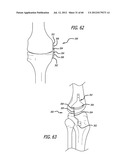 EXTRA-ARTICULAR IMPLANTABLE MECHANICAL ENERGY ABSORBING SYSTEMS AND     IMPLANTATION METHOD diagram and image