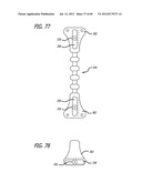 EXTRA-ARTICULAR IMPLANTABLE MECHANICAL ENERGY ABSORBING SYSTEMS AND     IMPLANTATION METHOD diagram and image