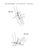 EXTRA-ARTICULAR IMPLANTABLE MECHANICAL ENERGY ABSORBING SYSTEMS AND     IMPLANTATION METHOD diagram and image