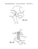 EXTRA-ARTICULAR IMPLANTABLE MECHANICAL ENERGY ABSORBING SYSTEMS AND     IMPLANTATION METHOD diagram and image