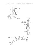 EXTRA-ARTICULAR IMPLANTABLE MECHANICAL ENERGY ABSORBING SYSTEMS AND     IMPLANTATION METHOD diagram and image