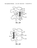 EXTRA-ARTICULAR IMPLANTABLE MECHANICAL ENERGY ABSORBING SYSTEMS AND     IMPLANTATION METHOD diagram and image