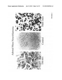 DIAGNOSIS AND TREATMENT OF NEUROECTODERMAL TUMORS diagram and image