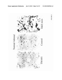 DIAGNOSIS AND TREATMENT OF NEUROECTODERMAL TUMORS diagram and image