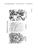 DIAGNOSIS AND TREATMENT OF NEUROECTODERMAL TUMORS diagram and image